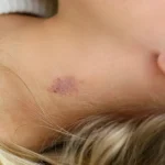 how to hide a hickey with makeup